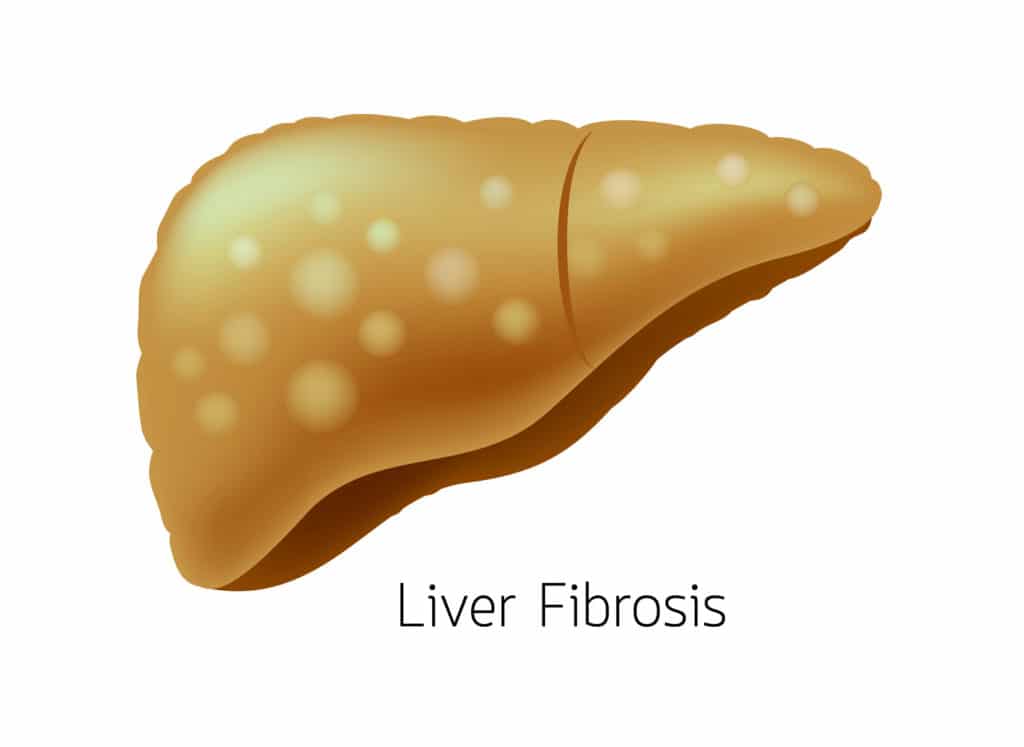 Liver Fibrosis