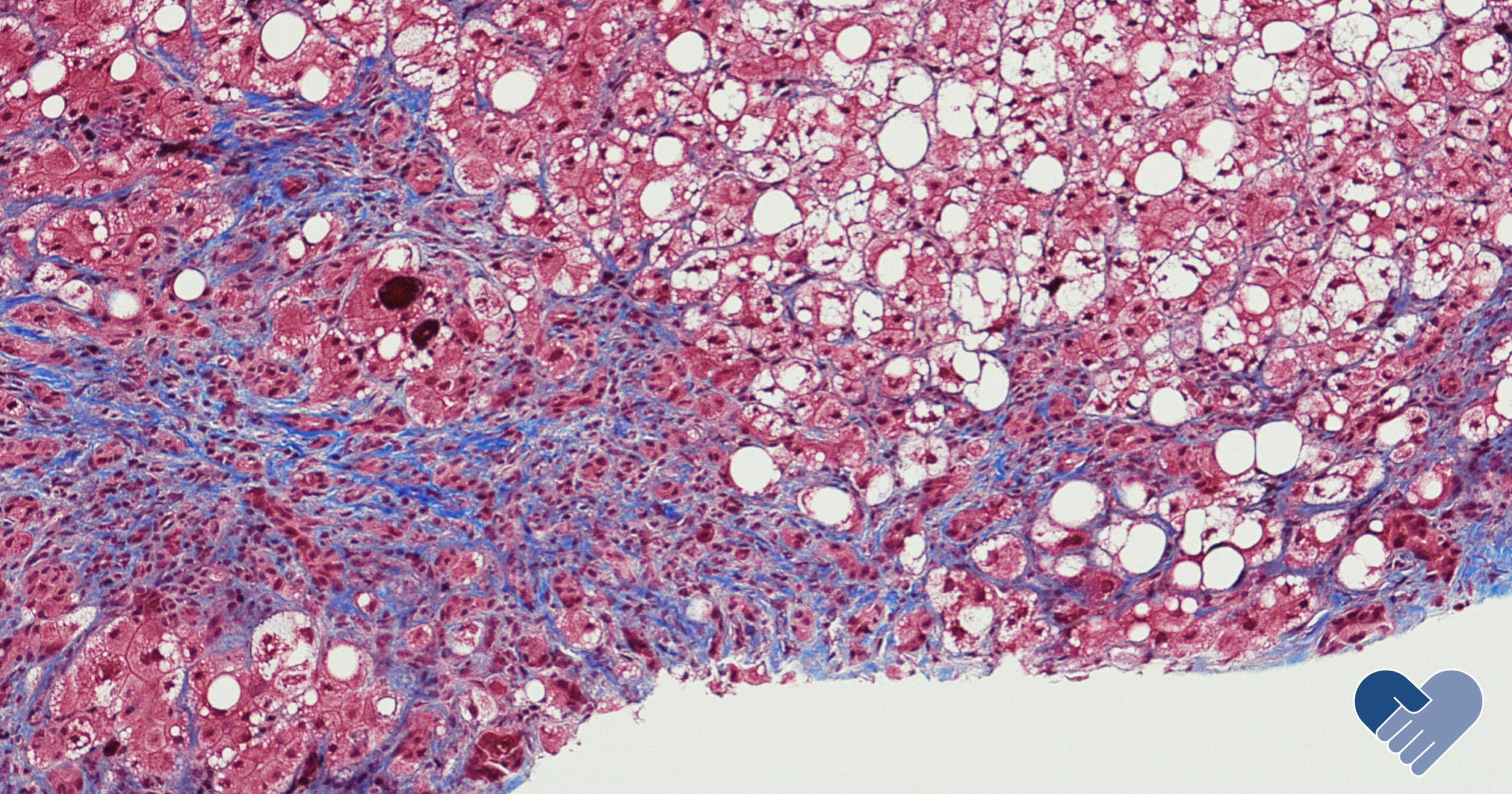 FFI - Blog Banner - What is Alcoholic Steatohepatitis