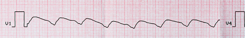 Ventricular Tachycardia