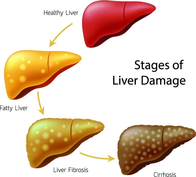 stages of liver damage